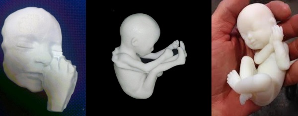 doctors-use-3d-printing-ensure-safe-delivery-high-risk-pregancy-1