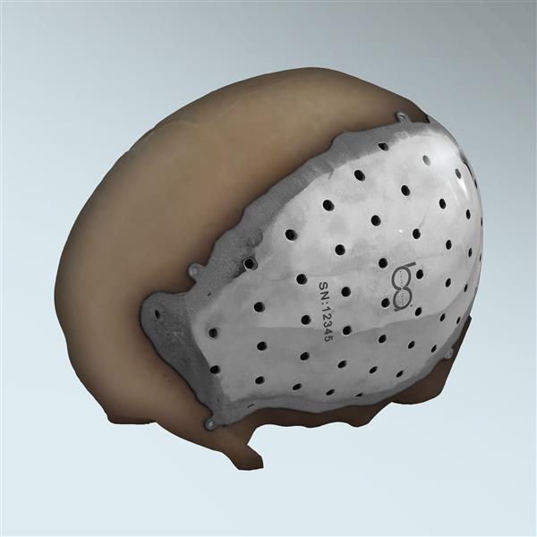 bioarchitects-arcam-announce-fda-approval-3dprinted-titanium-cranial-plate-implants-1