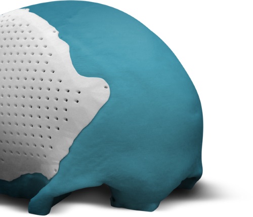 bioarchitects-arcam-announce-fda-approval-3dprinted-titanium-cranial-plate-implants-5