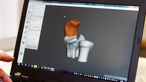 london-private-surgeon-boyd-goldie-adopts-3d-printing-for-surgical-planning-2