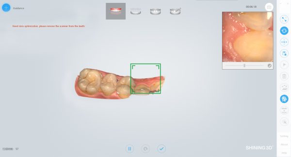 AoralScan2 Intra-oral Scan เครื่องสแกนเนอร์ในช่องปาก - Image 7