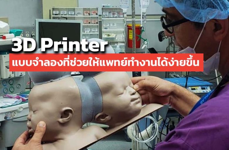 แพทย์ใช้ 3D Printer ทำแบบจำลองทารกฝาแฝดเพื่อใช้ศึกษาในการผ่าตัด