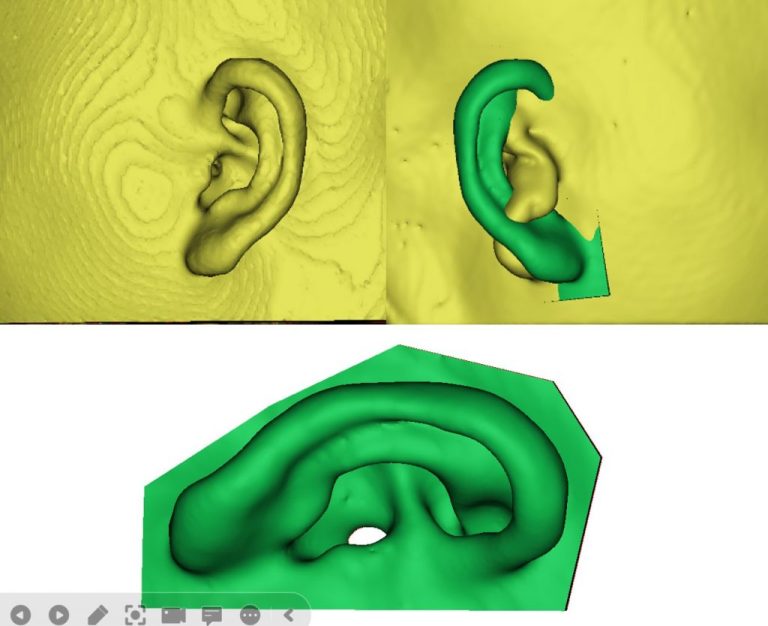 Read more about the article 3D Scanner ใช้สำหรับภาวะใบหูเล็กไม่สมบูรณ์ (microtia)
