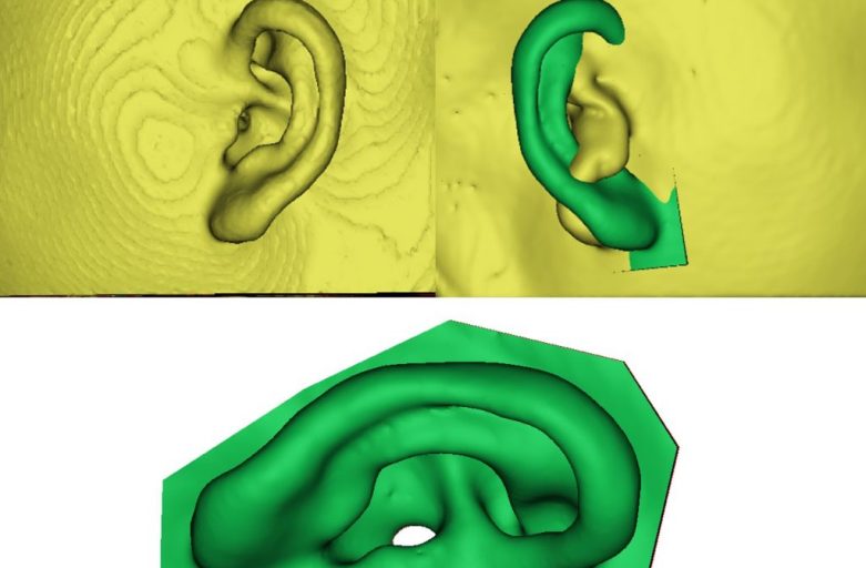 3D Scanner ใช้สำหรับภาวะใบหูเล็กไม่สมบูรณ์ (microtia)