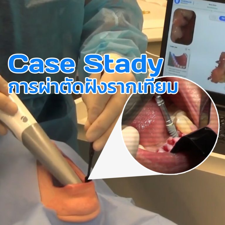 Read more about the article 3D Scanner ใช้งานร่วมกับทันตแพทย์ สำหรับการผ่าตัดฝังรากเทียม