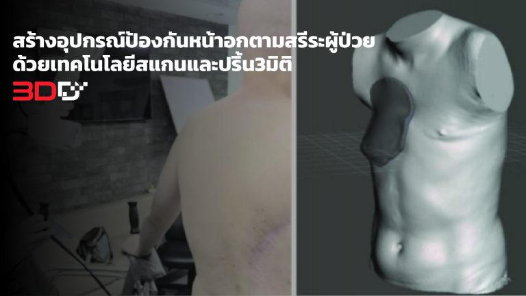 Read more about the article สร้างอุปกรณ์ป้องกันหน้าอกตามสรีระผู้ป่วย ด้วยเทคโนโลยีสแกนและปริ้น3มิติ