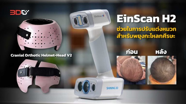Read more about the article EinScan H2 ช่วยในการปรับแต่งหมวกสำหรับพยุงกะโหลกศีรษะ