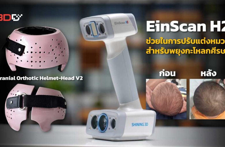 EinScan H2 ช่วยในการปรับแต่งหมวกสำหรับพยุงกะโหลกศีรษะ